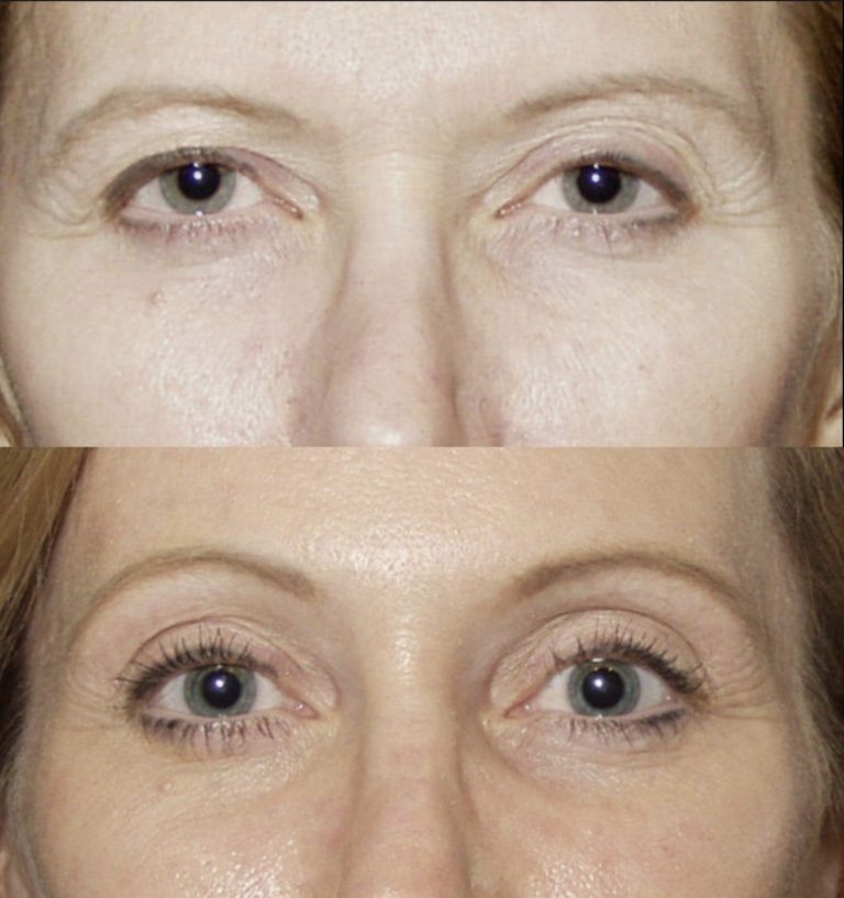 Before and three months after endoscopic brow lift without blepharoplasty. Front view.