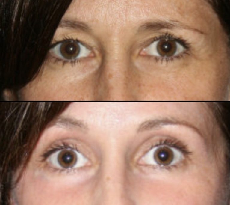 Before and three months after endoscopic brow lift without blepharoplasty. Oblique view.