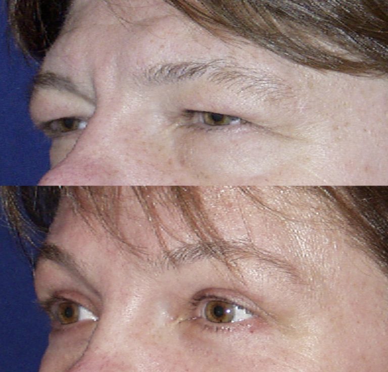 Before and three months after endoscopic brow lift with upper and lower blepharoplasty. Oblique view.