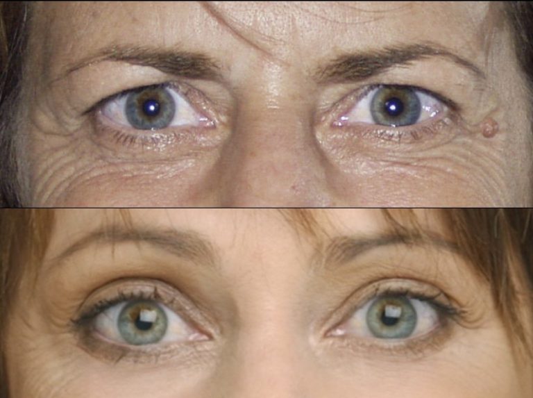 Before and three months after endoscopic brow lift with upper and lower blepharoplasty. Front view.