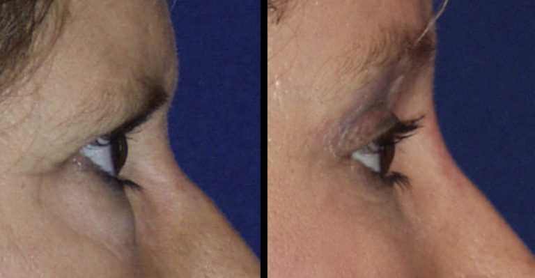 Before and three months after endoscopic brow lift with upper and lower blepharoplasty. Profile view.