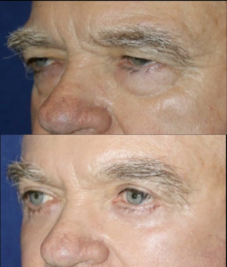 Before and three months after endoscopic brow lift with upper and lower blepharoplasty. Oblique view.