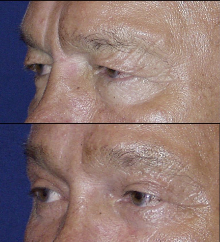 Before and three months after endoscopic brow lift with upper and lower blepharoplasty. Oblique view.