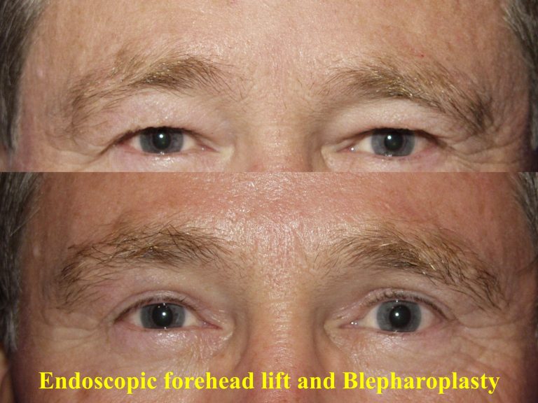 Before and three months after endoscopic brow lift with upper and lower blepharoplasty. Front view.